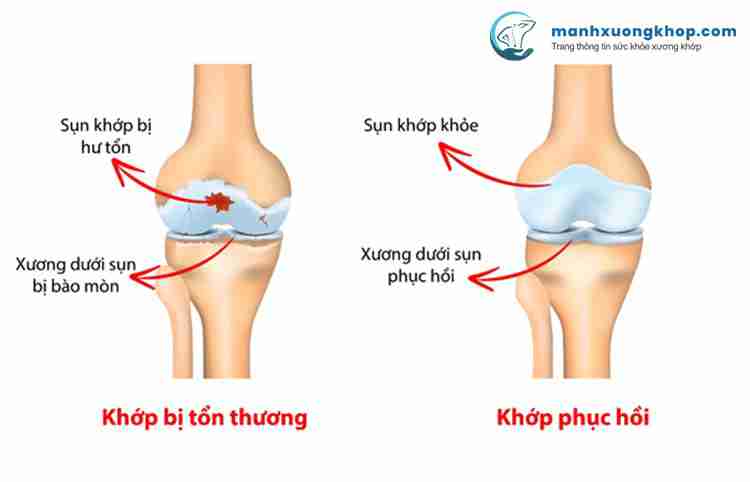 Thuốc xương khớp được sử dụng hổi phục các chức năng xương khớp